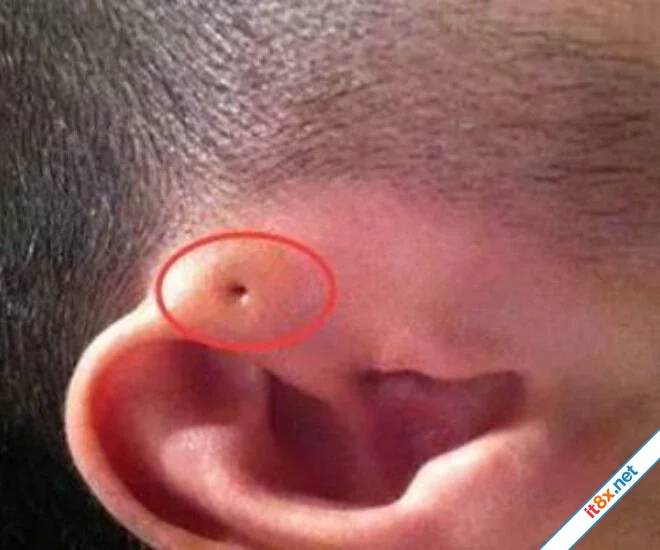 Mẹ phát hiện gần tai con xuất hiện một lỗ sâu khác thường liền tò mò bóp thử không ngờ bác sĩ...webp
