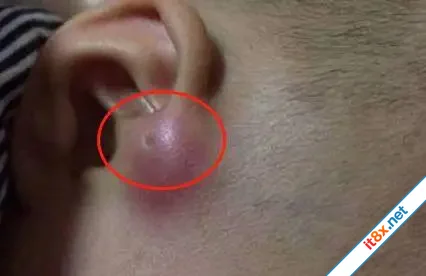 Mẹ phát hiện gần tai con xuất hiện một lỗ sâu khác thường liền tò mò bóp thử không ngờ bác sĩ...webp