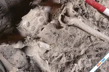 Phát hiện bệnh nhân ung thư vú đầu tiên của nhân loại