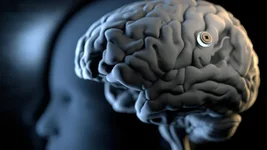 Trung Quốc tham vọng "lật đổ" Neuralink với công nghệ cấy chip não trong 10 phút